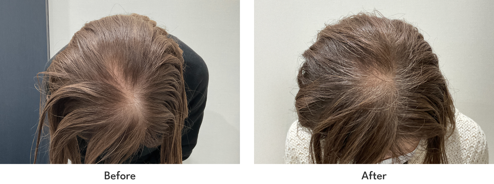 FAGA発毛プラン 6回コース