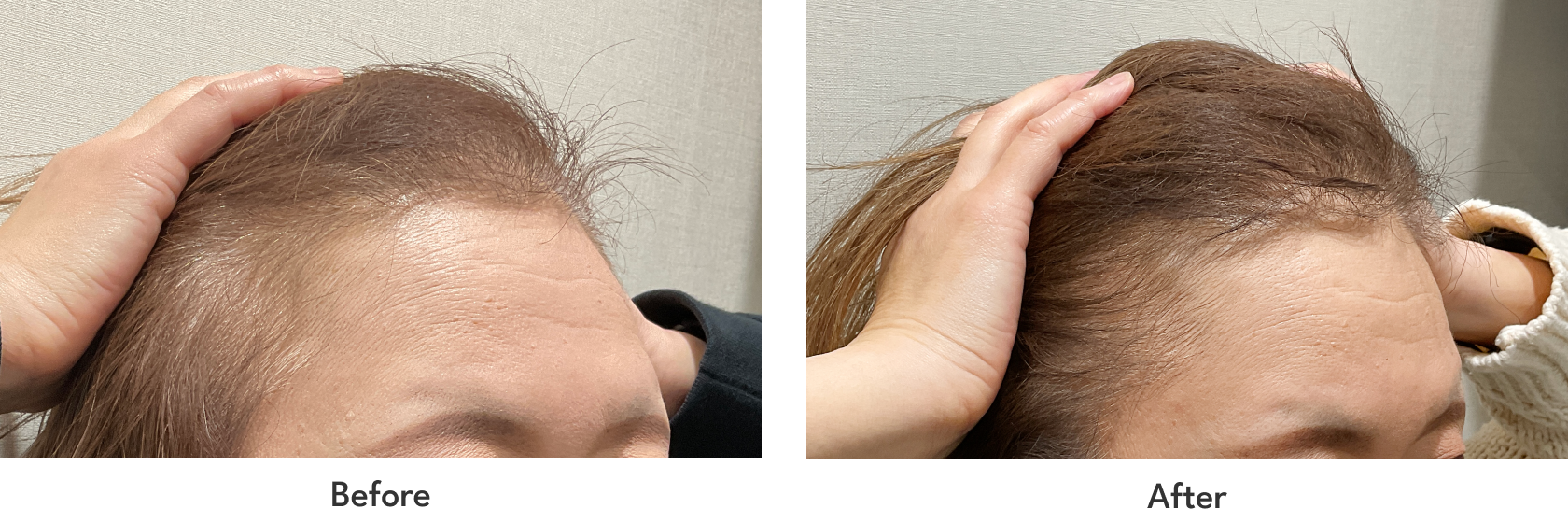 FAGA発毛プラン 6回コース