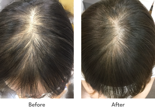 FAGA発毛プラン 6回コース